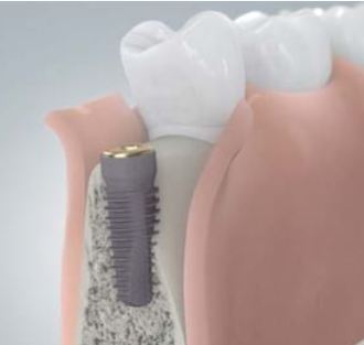 Zahnimplantat mit nicht ausreichendem Knochen Camlog