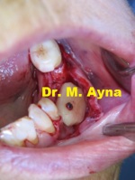 Knochenaufbau Zahnimplantat Dr. Ayna