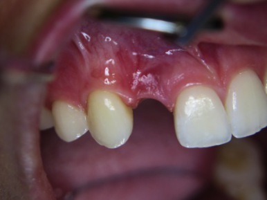 Patientin mit einem fehlenden Zahn der Praxis Dr. Ayna